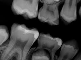 child dental x ray