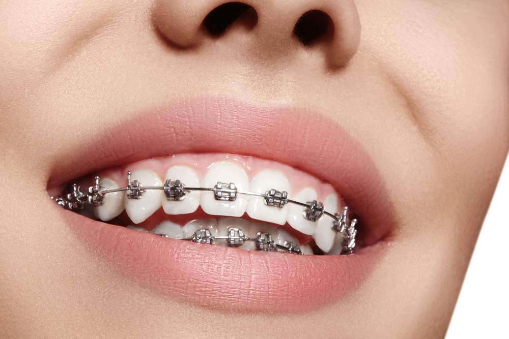 7 Things You Must Know Before Trying Braces