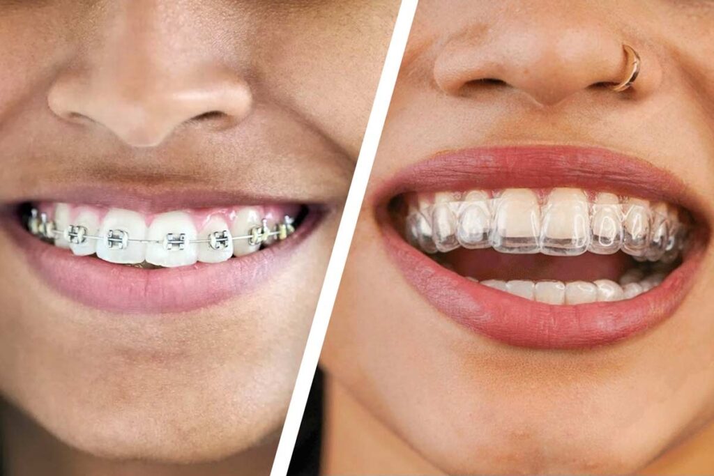 dental invisalign treatment