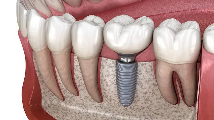All-on-4-dental-implants-Palmdale